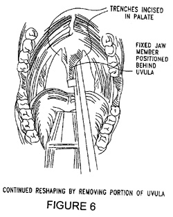 Reshaping Uvula